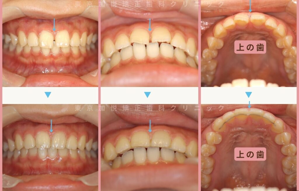 すきっ歯の治療前後写真
