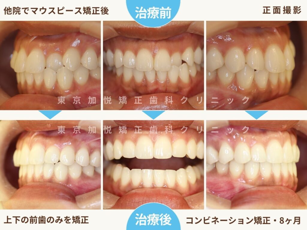 他院でマウスピース矯正した後当院で再矯正した症例