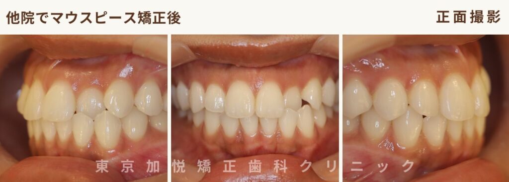 他院でマウスピース矯正した後の写真