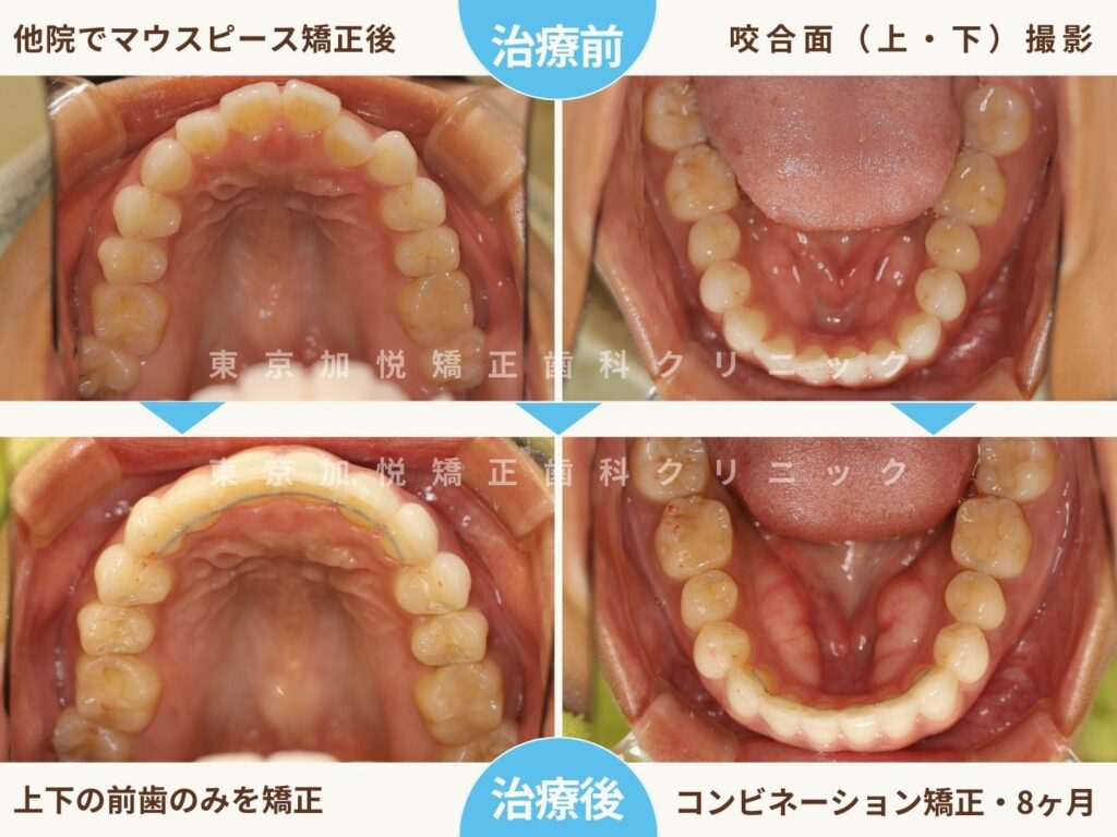 他院でマウスピース矯正した後当院で再矯正した症例