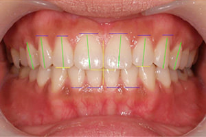 咬合が整った歯並び