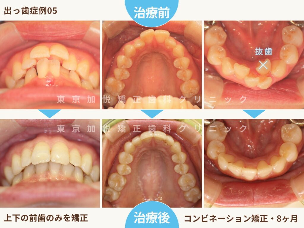 出っ歯を部分矯正で治療した前後写真