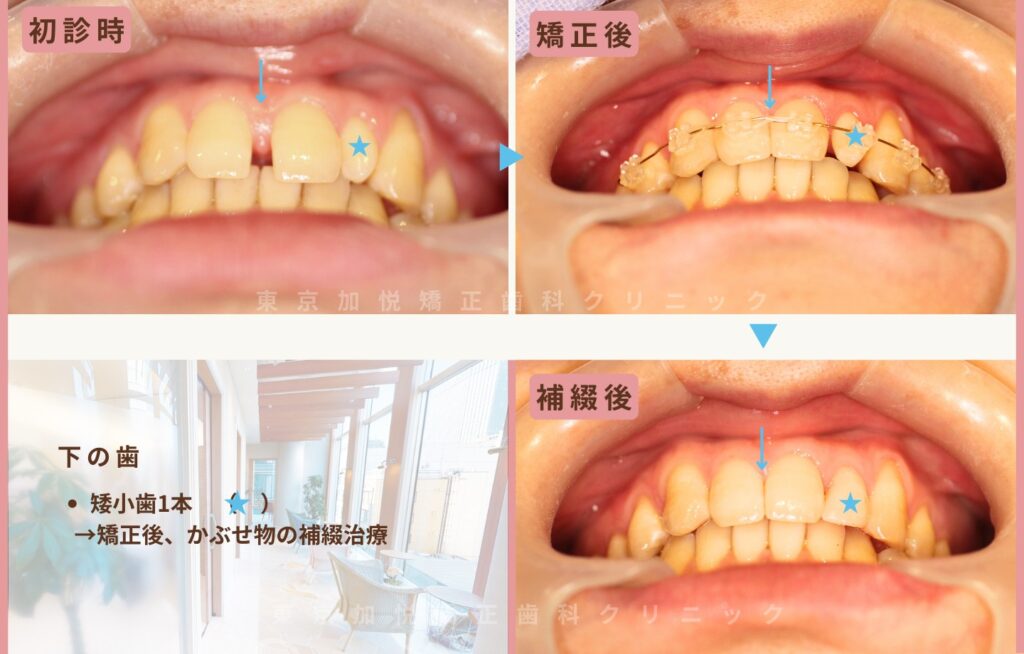 すきっ歯・矮小歯・欠損歯の治療前写真（正面下から写真）